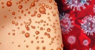 Başlık: Gana'da Maymun Çiçeği Virüsü Vaka Sayısı 583'e Yükseldi İçerik: