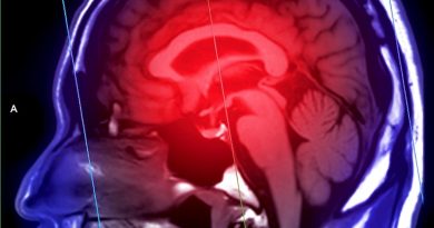 İnme Riski Gençlerde de Artıyor Nöroloji Uzmanı Dr Vugar Jafar: