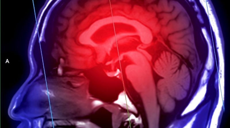 İnme Riski Gençlerde de Artıyor Nöroloji Uzmanı Dr Vugar Jafar: