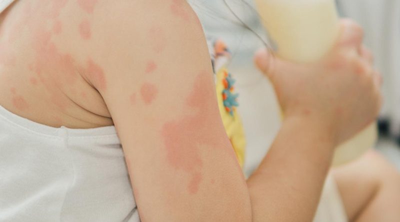 Here is the requested Turkish text: Başlık: Bebeklerde ve Çocuklarda