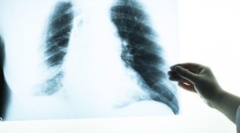 Sigara Kullanan 45 Yaş Üstü 4 Kişinden Birinde KOAH Görülüyor