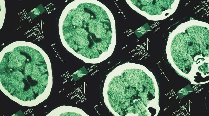 Günde 3 Bin Adım Atmak Alzheimer'ın İlerlemesini Yavaşlatabilir Güne 3