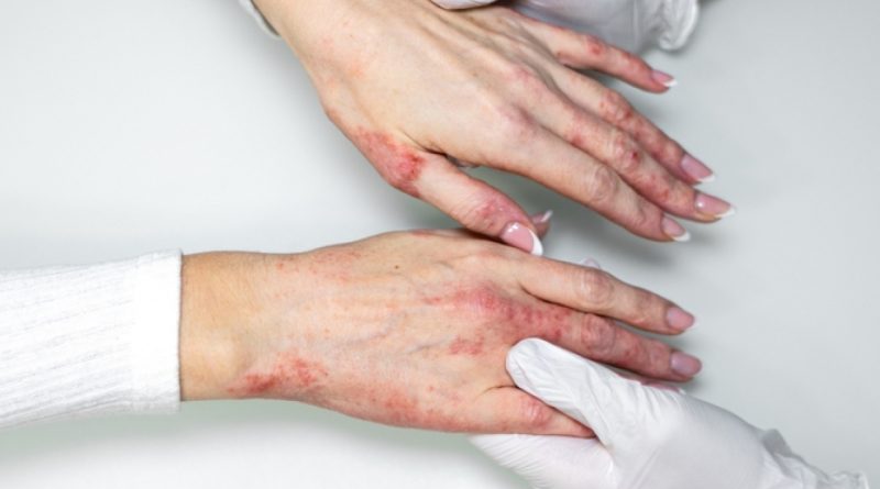 Cildin bariyeri zayıflıyor, egzama kendini gösteriyor