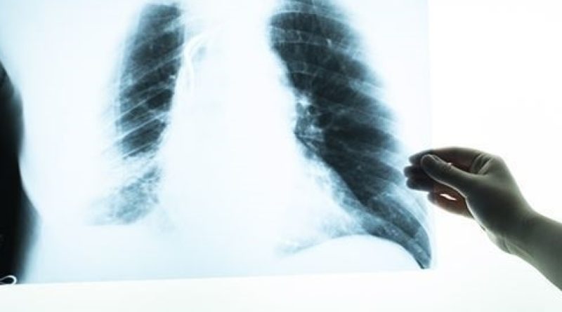 Öksürük, kilo kaybı ihmal etmeyin, tüberkülozu tanıyın
