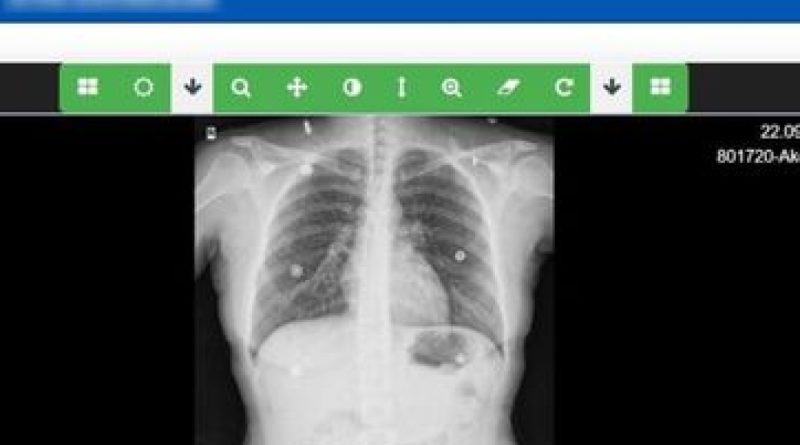 Verem tanısı artık daha hızlı ve kolay
